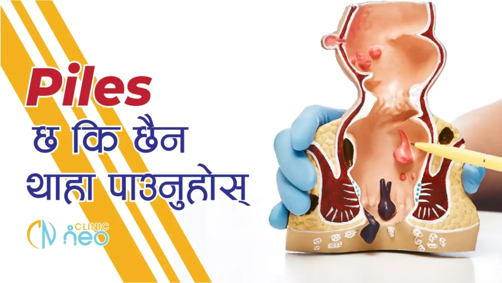 Know if you have piles or not