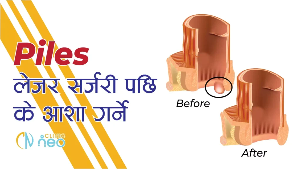 What do you expect after Piles Laser Surgery