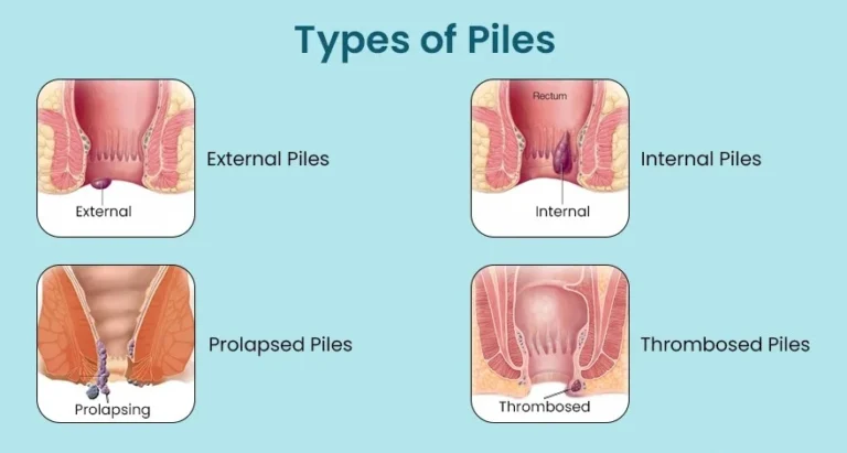 different types of piles