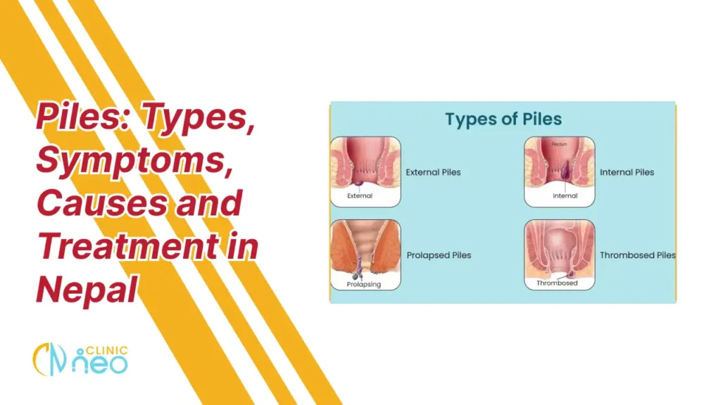 Educational graphic on piles with red text 'Piles: Types, Symptoms, Causes and Treatment in Nepal' beside illustrations of four types: external, internal, prolapsed, and thrombosed piles. Clinic Neo logo is at the bottom left.