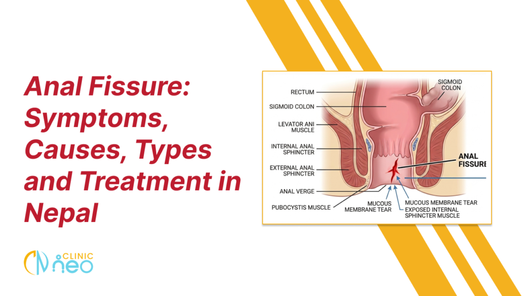 Banner titled "Anal Fissure: Symptoms, Causes, Types and Treatment in Nepal". On the left, large red text displays the title above the Clinic Neo logo. On the right, a labeled medical cross-sectional illustration of the rectum and anus highlights an anal fissure (a tear in the lining of the anal canal), with anatomical labels including the rectum, sigmoid colon, internal and external anal sphincters, and surrounding muscles. The background is white with diagonal yellow accent stripes.
