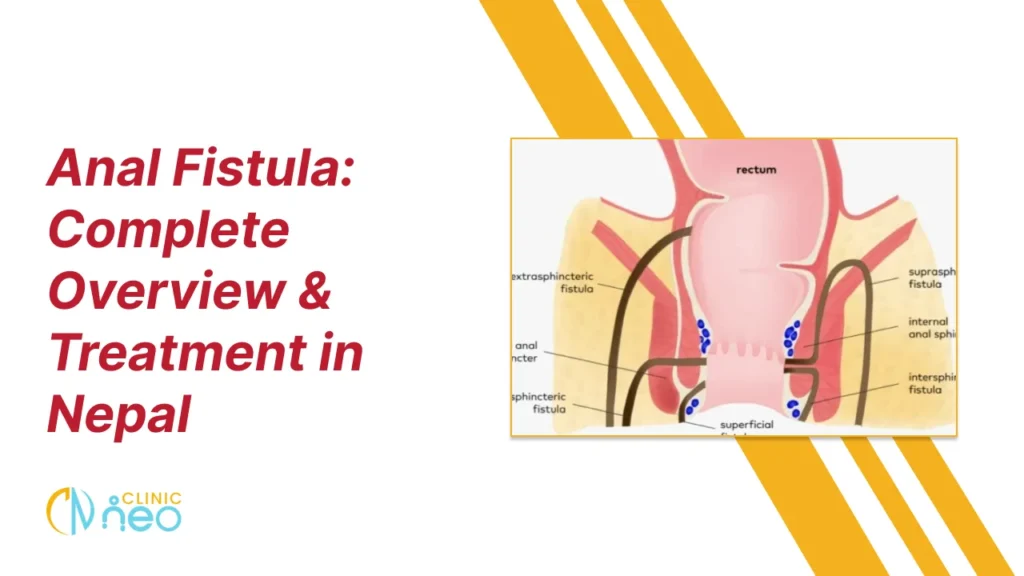 Illustration showing different types of anal fistula, including extrasphincteric, suprasphincteric, intersphincteric, and transsphincteric fistulas.