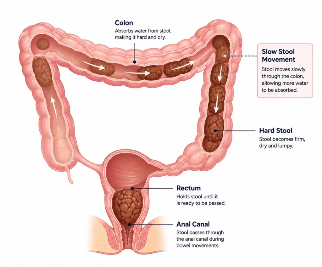 Illustration of the large intestine showing constipation, with stool moving slowly through the colon, allowing excess water to be absorbed and resulting in hard, dry, lumpy stool. Labels identify the colon, slow stool movement, hard stool, rectum, and anal canal.